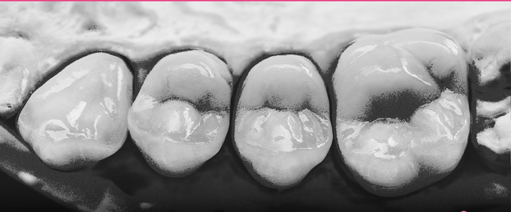 Aperfeiçoamento em Dentística Restauradora